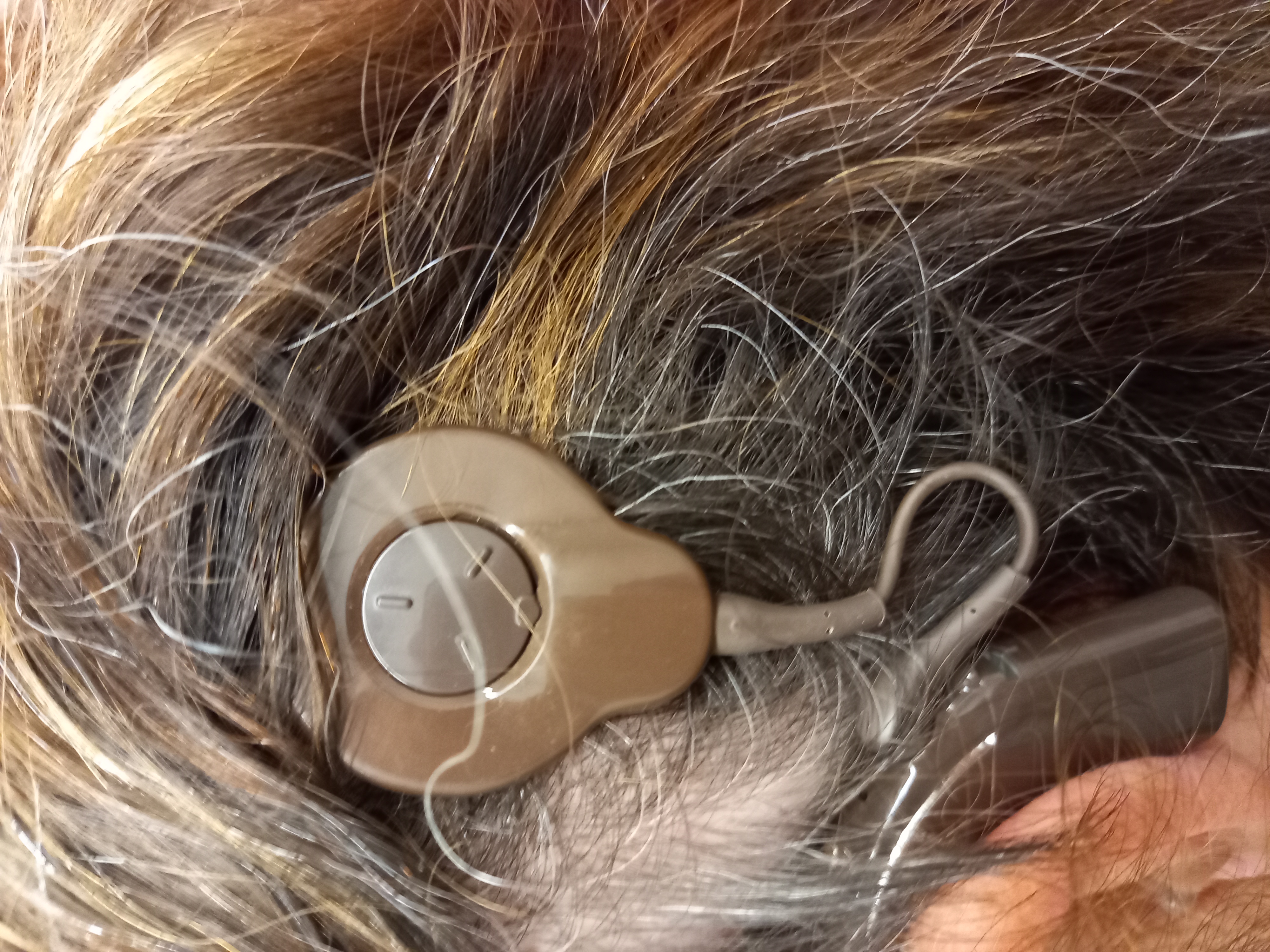 Image of Janet's cochlear implant device